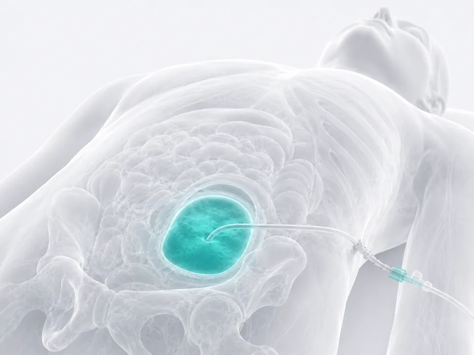 Abscess Drainage — image-guided procedure by Dr. Jeffrey Apo, Interventional Radiologist in Manila