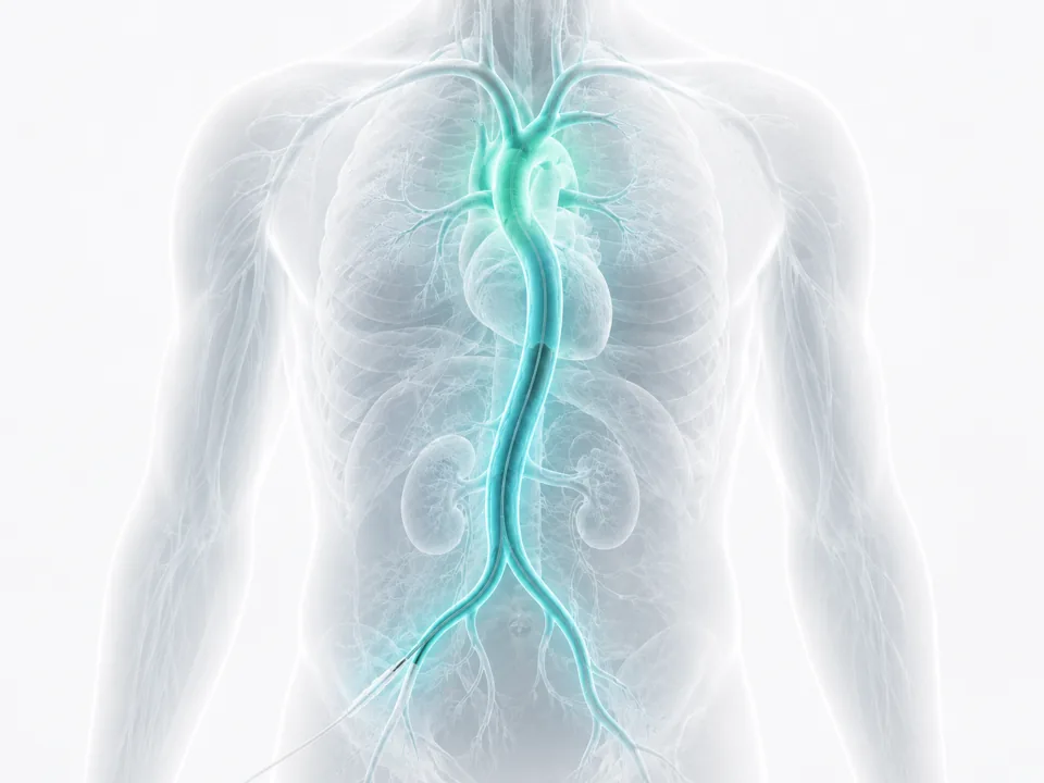 Angiography — image-guided procedure by Dr. Jeffrey Apo, Interventional Radiologist in Manila