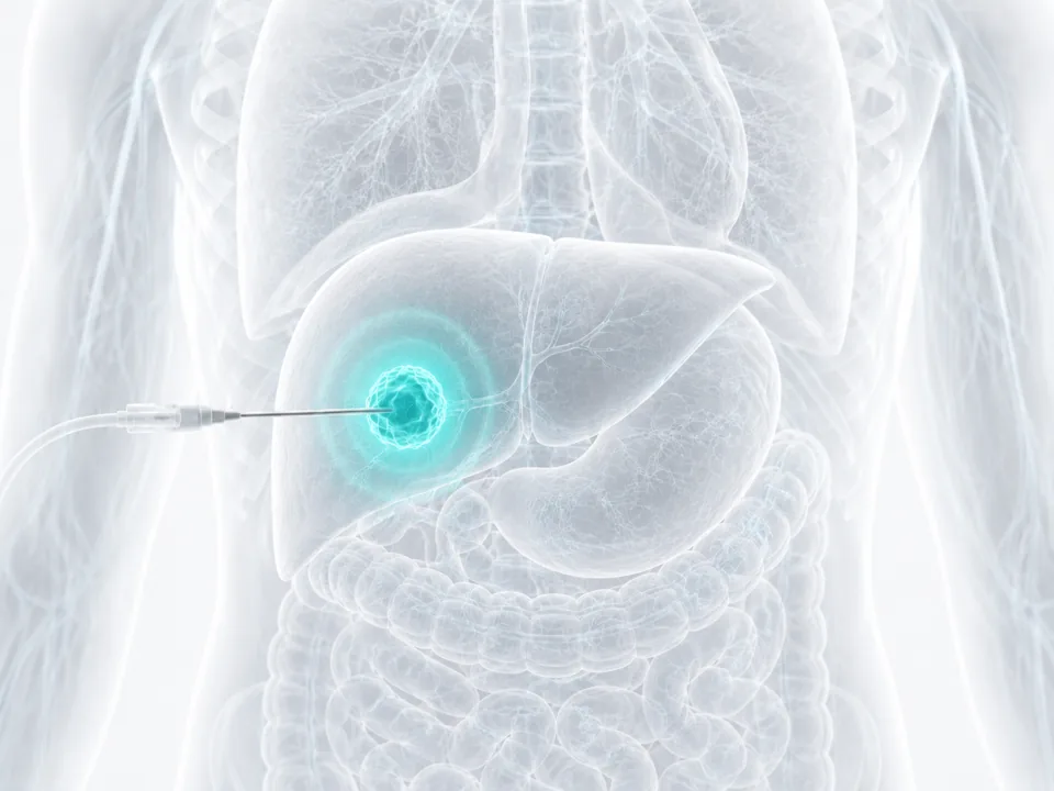 Microwave Ablation — image-guided procedure by Dr. Jeffrey Apo, Interventional Radiologist in Manila