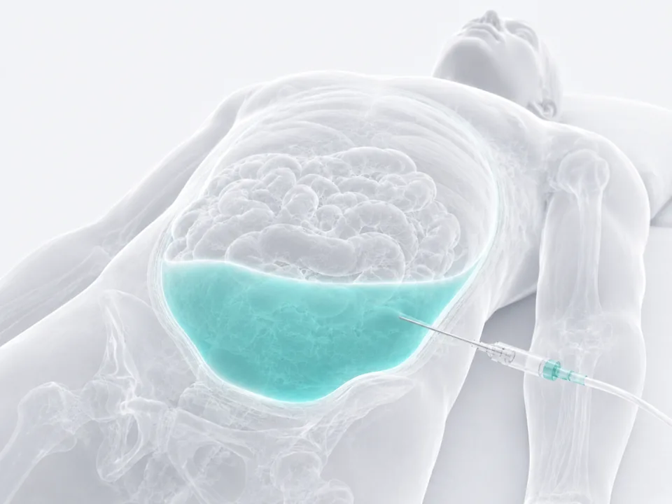 Paracentesis — image-guided procedure by Dr. Jeffrey Apo, Interventional Radiologist in Manila