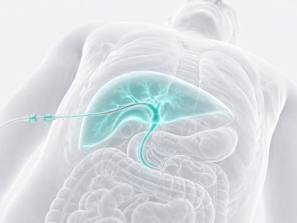 Biliary Drainage (PTBD) — image-guided procedure by Dr. Jeffrey Apo, Interventional Radiologist in Manila