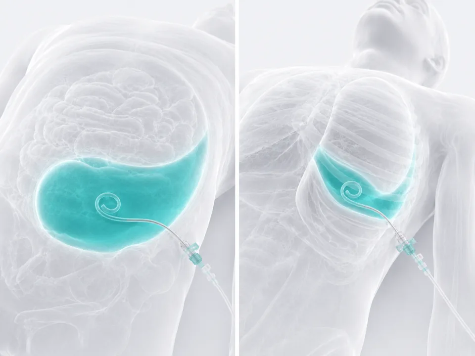 Pigtail Catheter Insertion — image-guided procedure by Dr. Jeffrey Apo, Interventional Radiologist in Manila