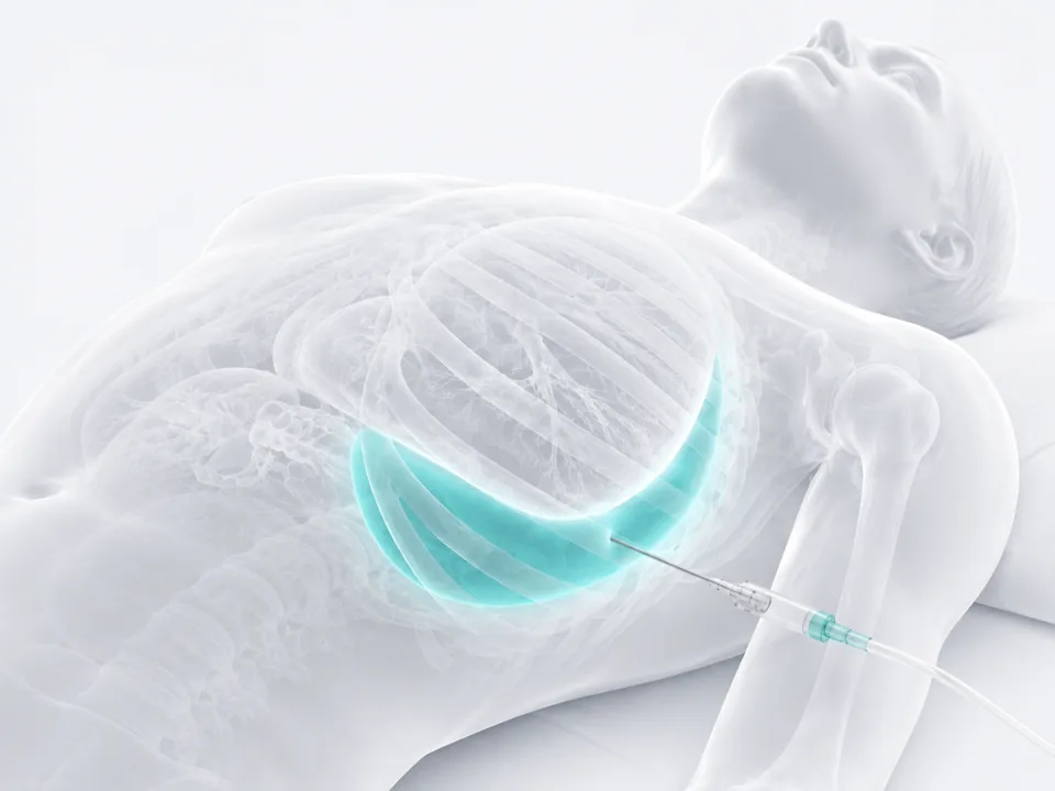 Thoracentesis — image-guided procedure by Dr. Jeffrey Apo, Interventional Radiologist in Manila