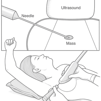 Ultrasound‑Guided Biopsy2