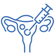 Uterine-Fibroid-Embolization