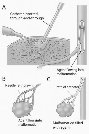 sclerotherapy