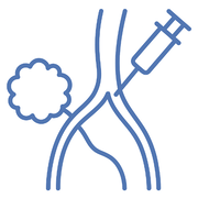 tumor-embolization
