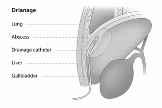 Abscess Drainage Abscess Drainage