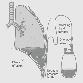 Pigtail Catheter Insertion Pigtail Catheter Insertion